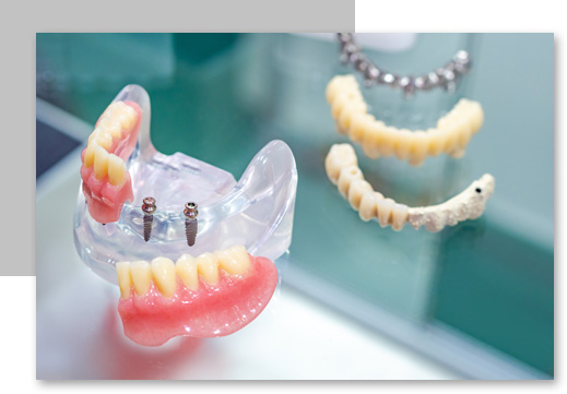 La conception des prothèses dentaires